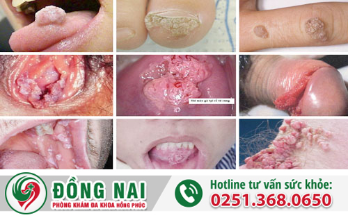 mụn cóc sinh dục