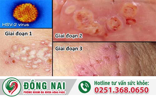 Mụn rộp sinh dục ở nam giới qua 3 giai đoạn