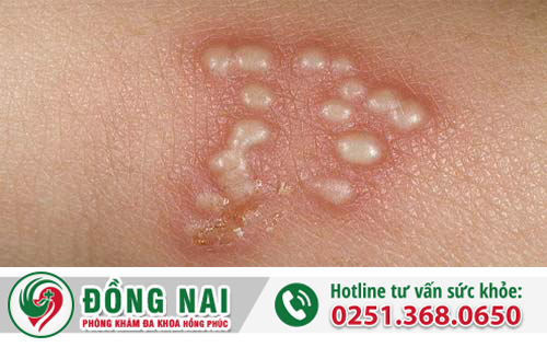 Mụn rộp sinh dục do virus Herpes Simplex (HSV) gây ra