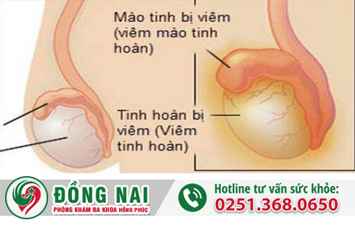 Năm nguyên nhân phổ biến gây viêm mào tinh hoàn ở nam giới