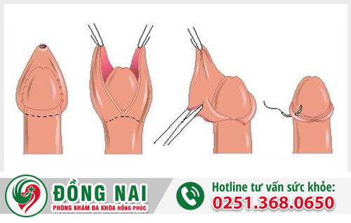 Cắt hẹp bao quy đầu 