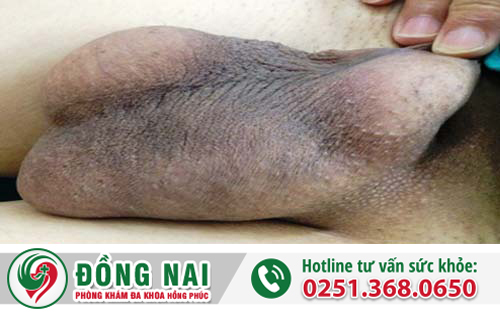 Nguyên nhân sưng tinh hoàn và cách chữa trị
