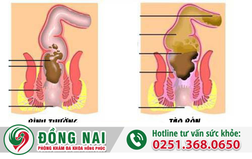 Nguyên nhân táo bón