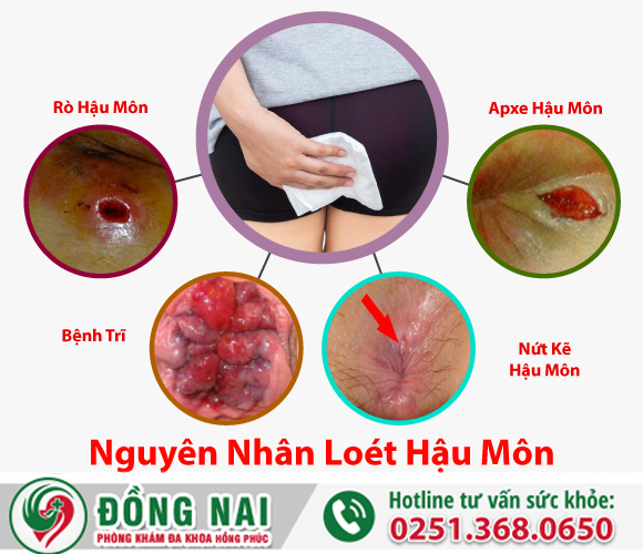 Nguyên nhân và biến chứng loét hậu môn