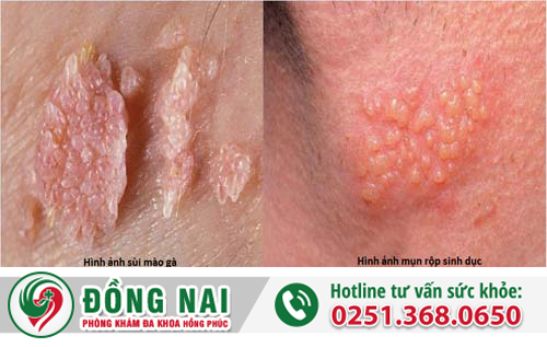Nhận biết mụn sinh dục là gì?