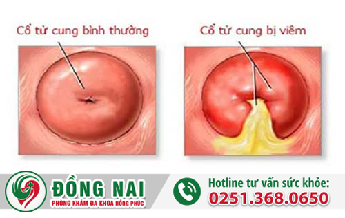 Những dấu hiệu và triệu chứng của bệnh viêm cổ tử cung