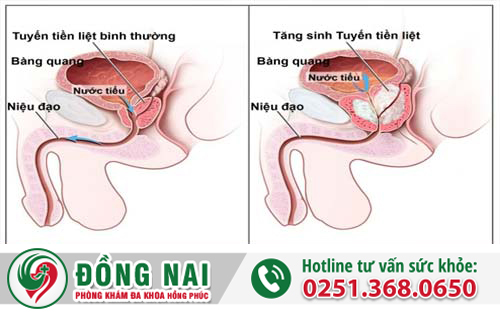 Những điều nam giới cần biết về phì đại tuyến tiền liệt