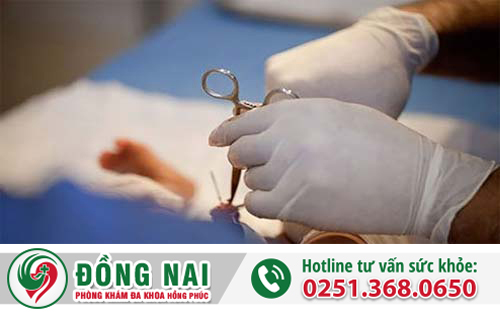 Những lợi ích của cắt bao quy đầu mang lại là gì?