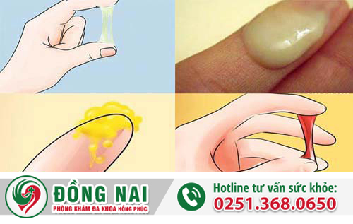 Những triệu chứng của bệnh viêm âm đạo