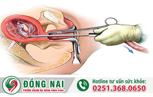 Phá thai an toàn bằng phương pháp hút thai