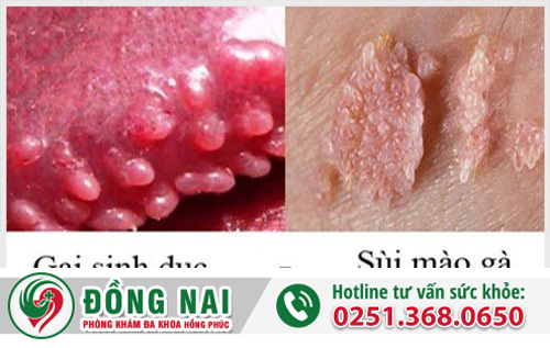 Phân biệt gai sinh dục với sùi mào gà