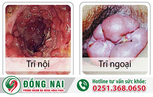 Các loại bệnh trĩ