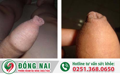 Một hình ảnh dài bao quy đầu trong thực tế