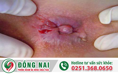Sa búi trĩ là bệnh gì – Dấu hiệu, nguyên nhân, điều trị ra sao?