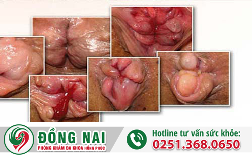 Dấu hiệu của bệnh sa búi trĩ
