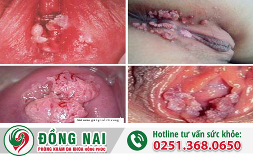 Sáu nguyên nhân chủ yếu gây ngứa vùng kín ở nữ
