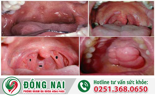 Sùi mào gà ở họng là bệnh gì?