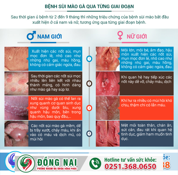 Sùi mào gà qua từng giai đoạn