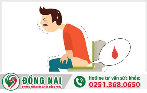 Đại tiện ra máu là triệu chứng ban đầu của trĩ ngoại