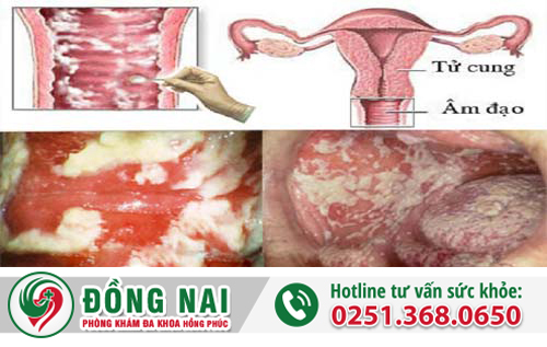 Tại sao bạn bị ngứa âm đạo và ngứa âm hộ?
