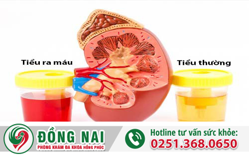 Tại sao nam giới tiểu ra máu?