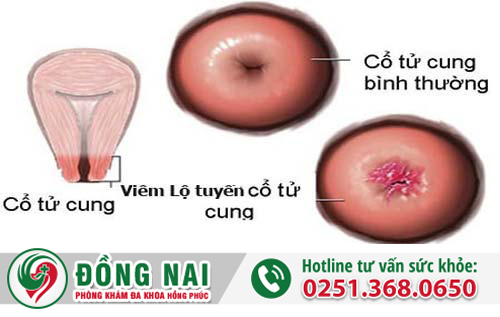 Tại sao phụ nữ bị vô sinh?