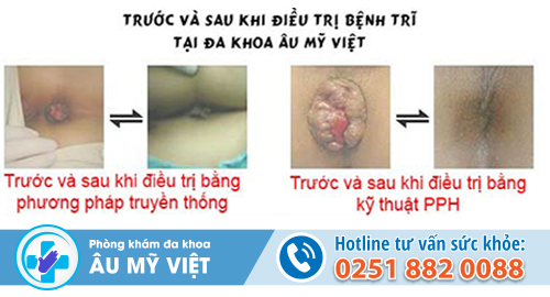 Bệnh trĩ có chữa được không?