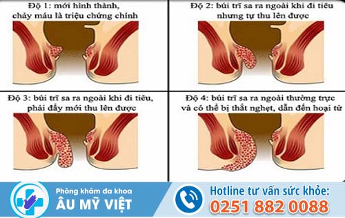 Tin vui cho bệnh nhân bị trĩ nội