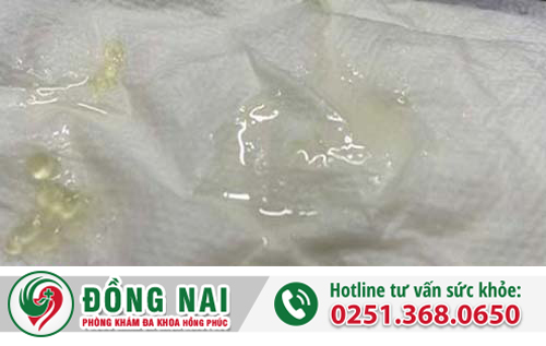 Tinh trùng vón cục – Nỗi hoang mang của nam giới