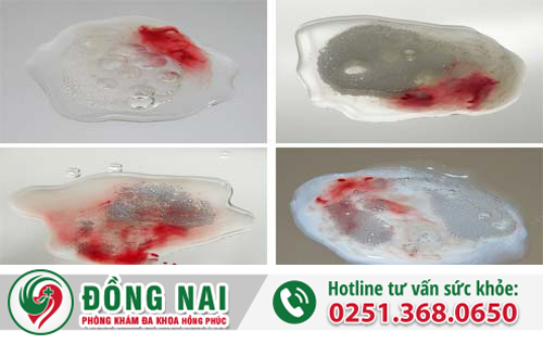 Tổng quan về bệnh xuất tinh ra máu