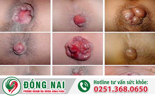 trĩ hỗn hợp