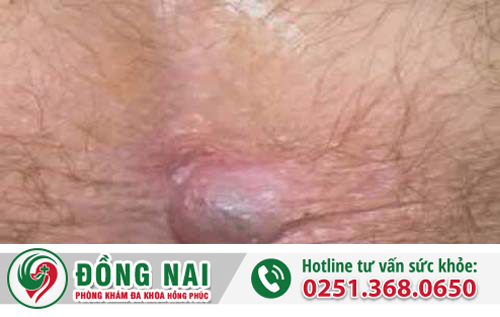 trĩ ngoại độ 1