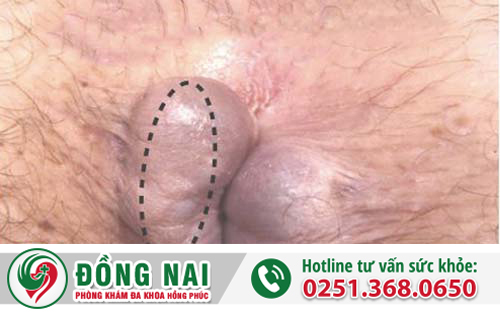 trĩ ngoại độ 2