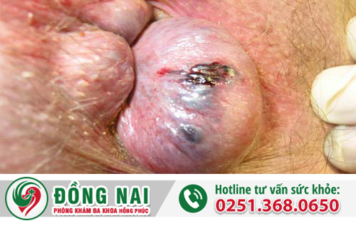 trĩ ngoại độ 3