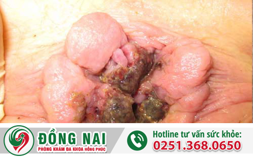 trĩ ngoại độ 4