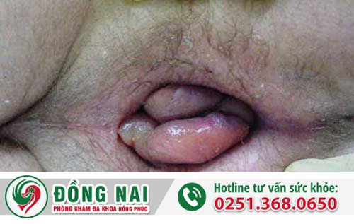 Nhận biết bệnh trĩ nội cấp độ 3