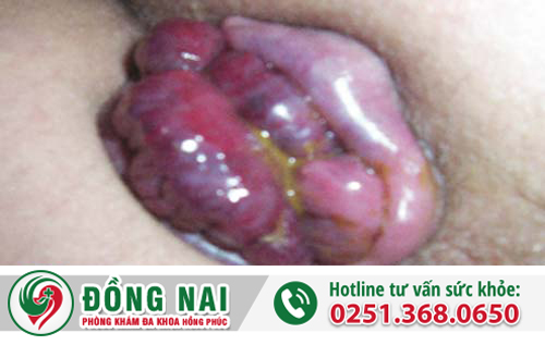 Nhận biết bệnh trĩ nội cấp độ 4 và cách điều trị