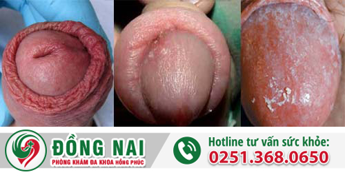 Viêm bao quy đầu – Căn bệnh thường gặp ở nam giới