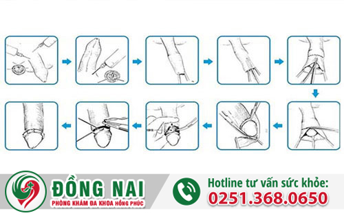 Viêm bao quy đầu được điều trị như thế nào?