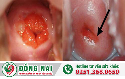 Điều trị viêm lộ tuyến cổ tử cung ra sao?