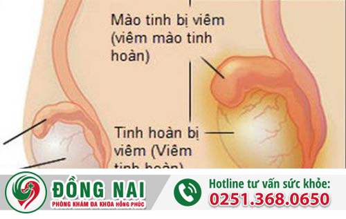 Viêm tinh hoàn ở nam giới