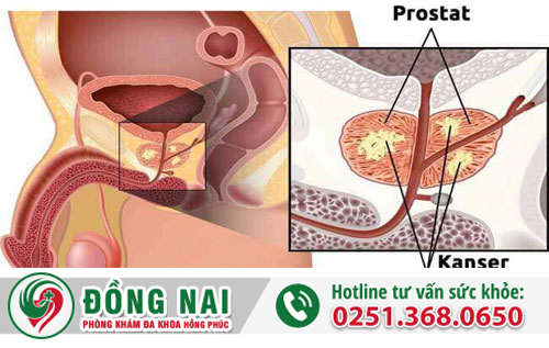 Vôi hóa tuyến tiền liệt là bệnh gì, có nguy hiểm không?